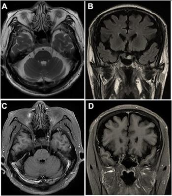 Case report: 18F-FDG PET confirmed pupil-sparing third nerve palsy heralding aseptic cavernous sinus embolism in patient with chest malignancy